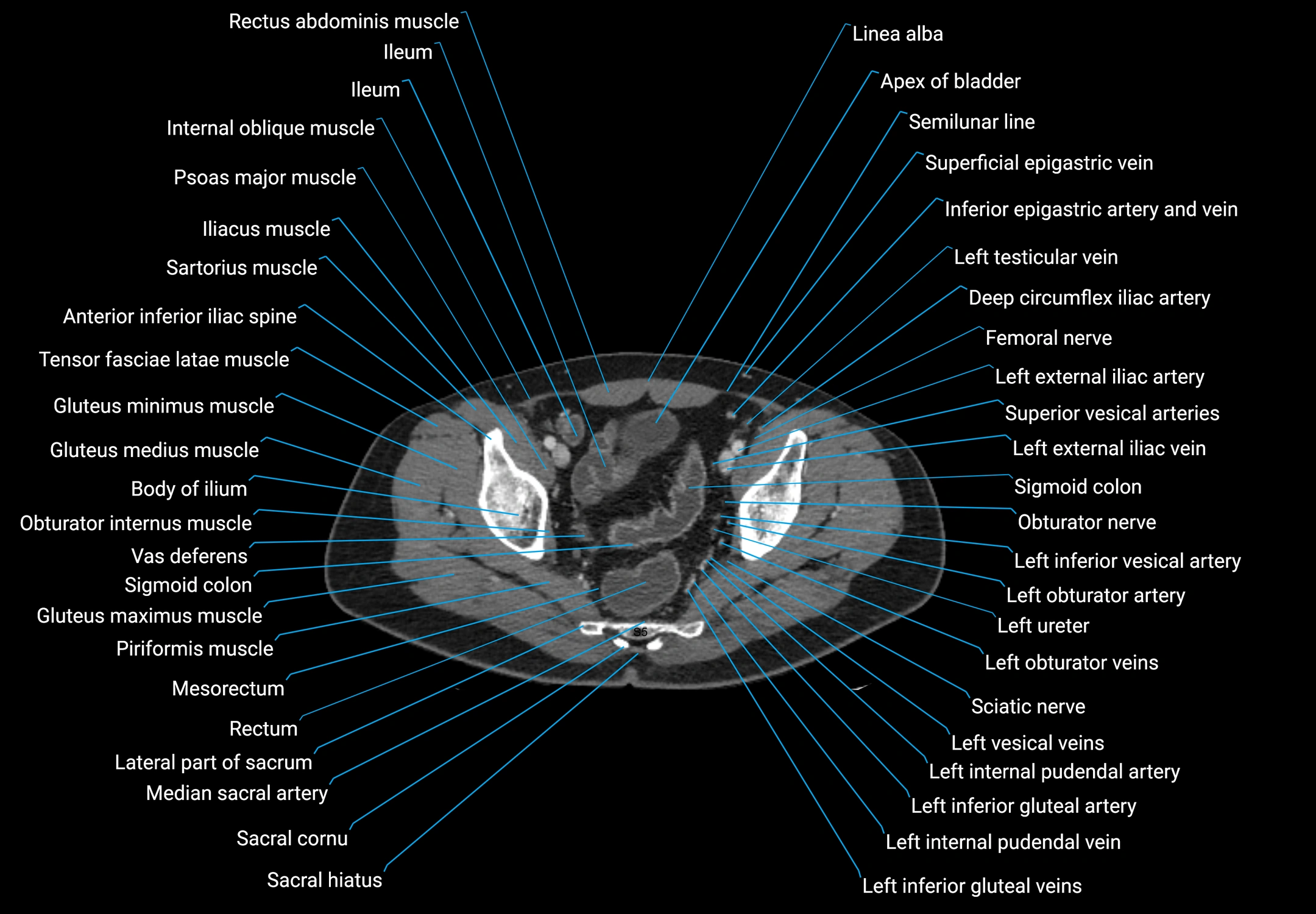 CT male pelvis axial cross sectional anatomy labelled radiology image -00173.webp